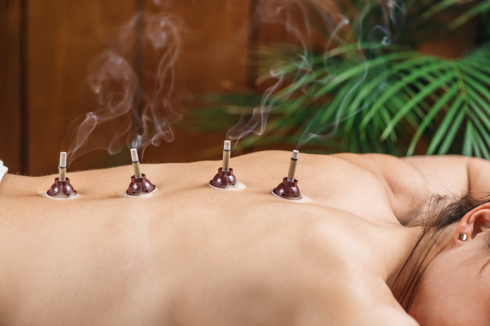 Moxibustion Traditional Chinese Medicine technique